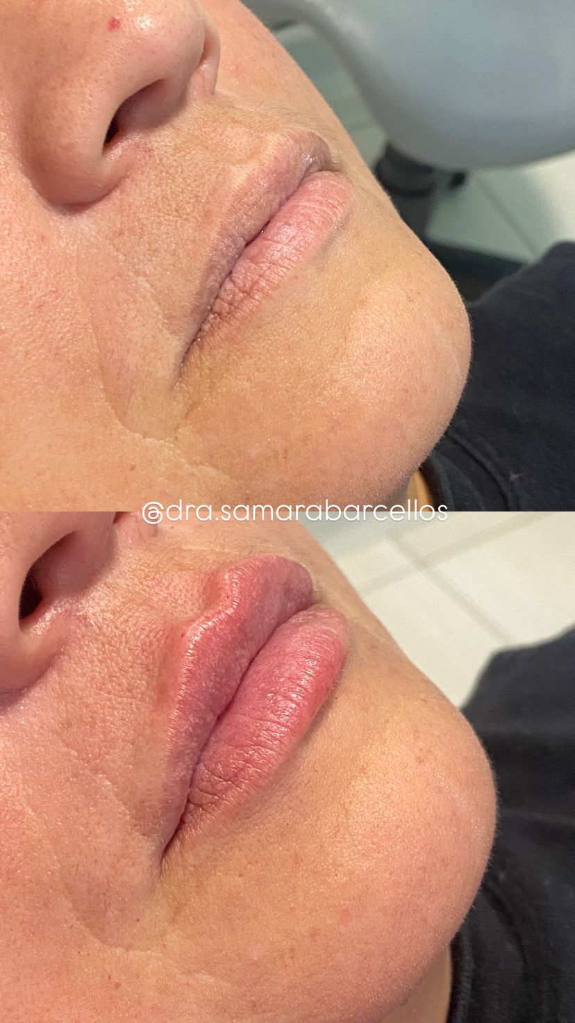 Preenchimento Labial